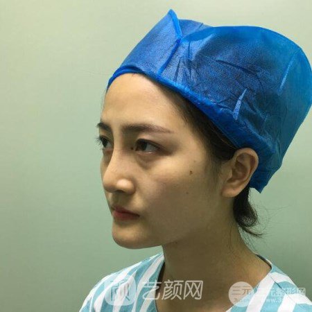 武漢華亞李愛(ài)林自體脂肪面部填充三個(gè)月案例分享~